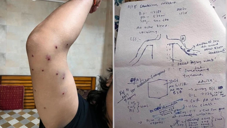 Delhi Police Denies Pellet Gun Use as Hospital Confirms Protester Suffered Pellet Injuries at Jantar MantarDelhi Police Denies Pellet Gun Use as Hospital Confirms Protester Suffered Pellet Injuries at Jantar Mantar